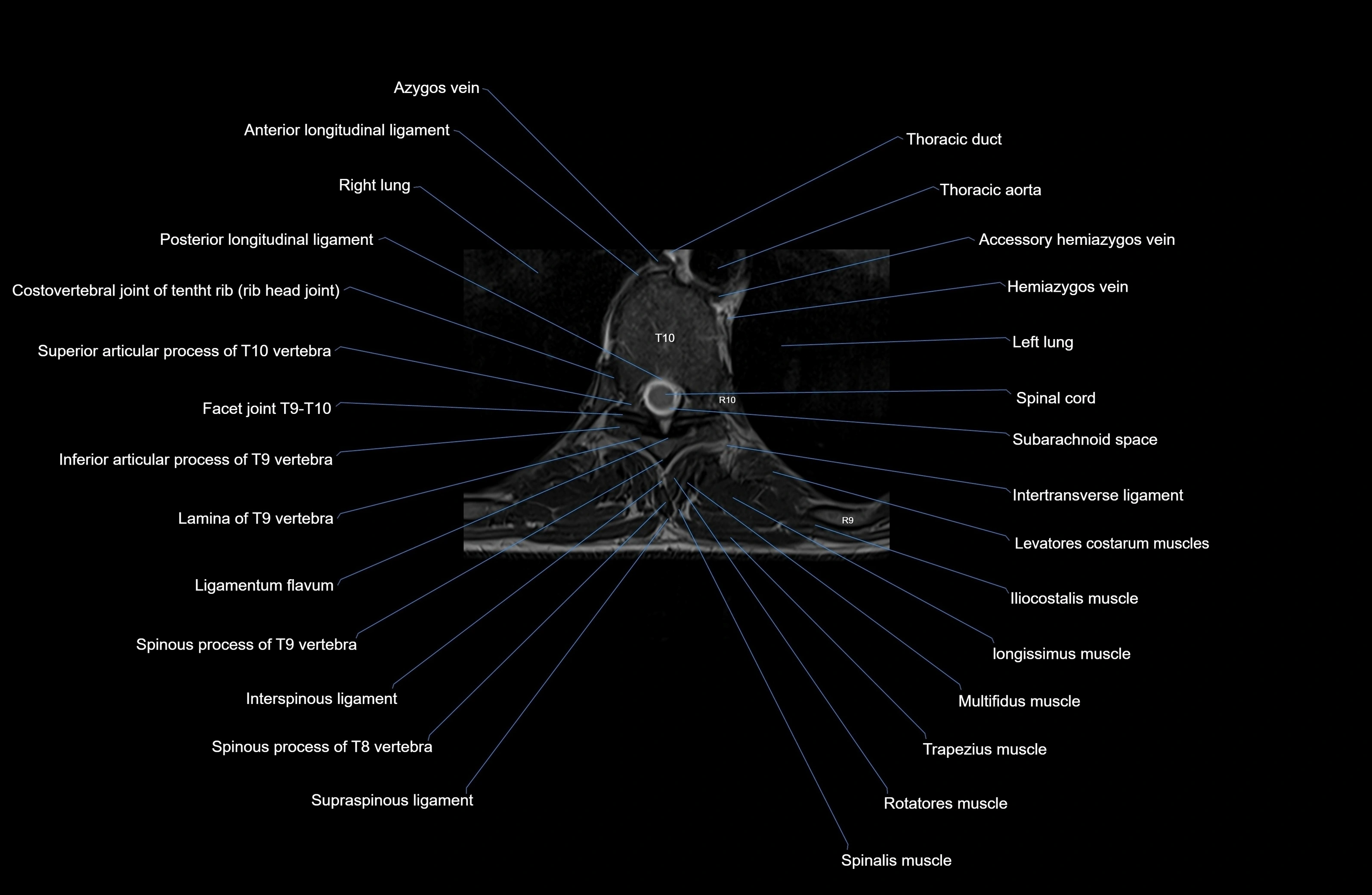 MRI thoracic spine axial  cross sectional anatomy 3T radiology  image-img-00001-00063.webp